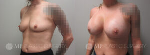 Fort Worth Breast Augmentation Patient 10 Oblique