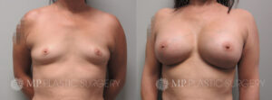 Fort Worth Breast Augmentation Patient 11 Front
