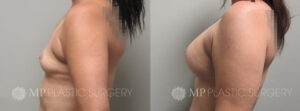 Fort Worth Breast Augmentation Patient 11 Side