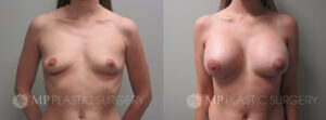 Fort Worth Breast Augmentation Patient 9 Front