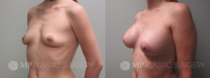 Fort Worth Breast Augmentation Patient 9 Oblique