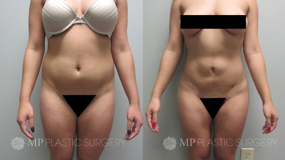 Fort Worth Brazilian Butt Lift Before & After Patient 1 Front