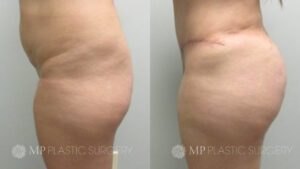Fort Worth Brazilian Butt Lift Before & After Patient 2 Side