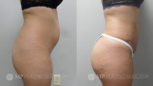 Fort Worth Brazilian Butt Lift Before & After Patient 3 Side