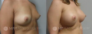 Fort Worth Breast Augmentation Patient 3 Oblique