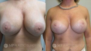 Fort Worth Breast Lift Patient 4 Front