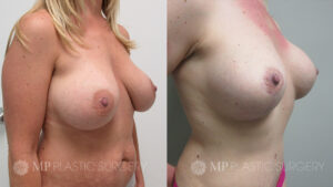Fort Worth Breast Lift Patient 7 Oblique