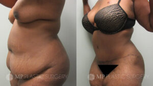 Fort Worth Tummy Tuck Before & After Patient 1 Oblique
