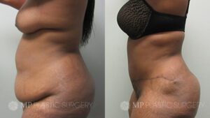 Fort Worth Tummy Tuck Before & After Patient 1 Side