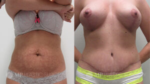 Fort Worth Tummy Tuck Before & After Patient 3 Front