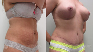 Fort Worth Tummy Tuck Before & After Patient 3 Left Oblique