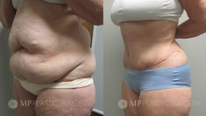 Fort Worth Tummy Tuck Before & After Patient 6 Oblique