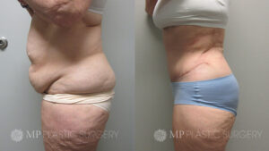 Fort Worth Tummy Tuck Before & After Patient 6 Side