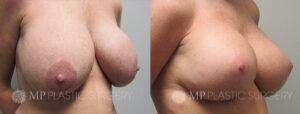 Fort Worth Breast Lift Patient 3 Oblique 1